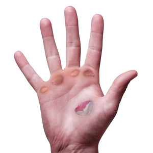 hand full of blisters from not using palm protection